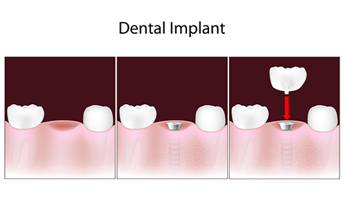 dental implants in coldwater